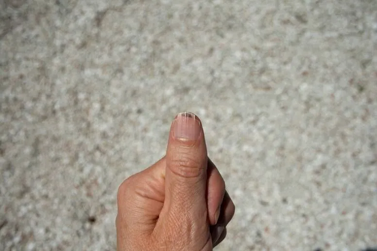 Rozdwajające się paznokcie – jakie są przyczyny i jak temu zaradzić?