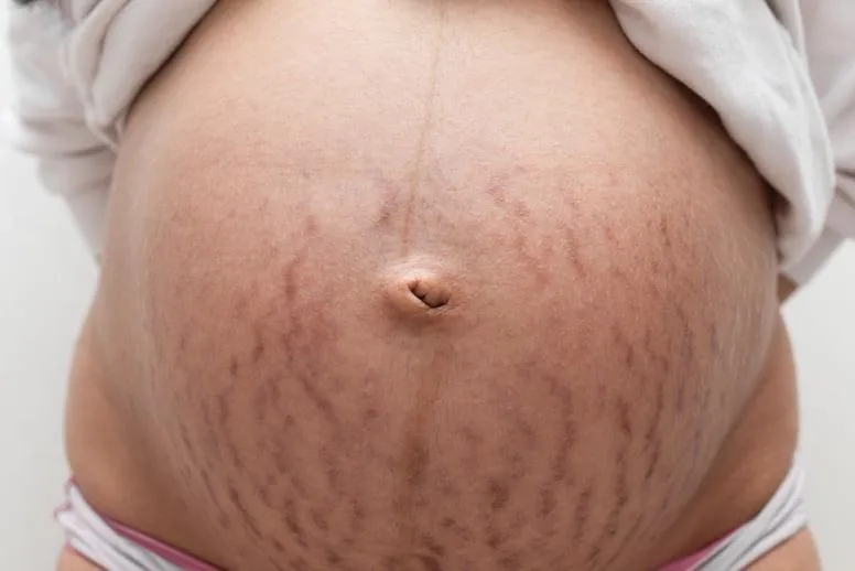 Rozstępy w ciąży – dlaczego powstają i w jaki sposób z nimi walczyć?