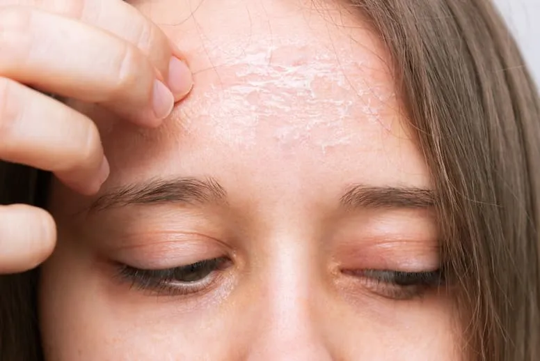 Łuszcząca się skóra na twarzy – domowe sposoby
