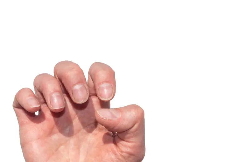 Rozdwajanie paznokci – przyczyny 