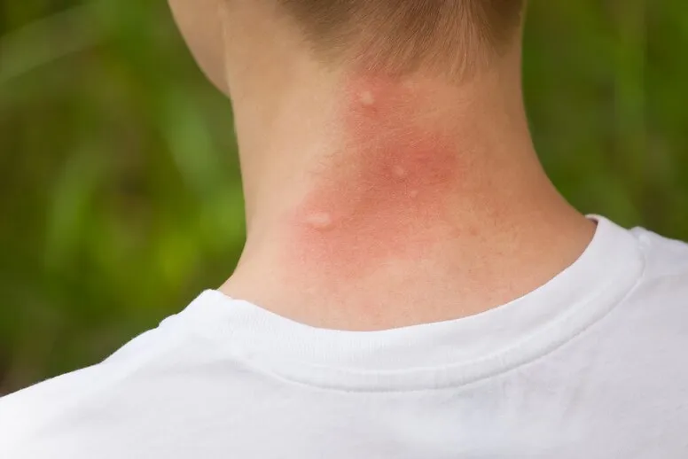 Jak złagodzić ugryzienie komara?