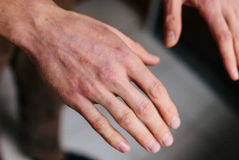 Co robić gdy pęka skóra na dłoniach