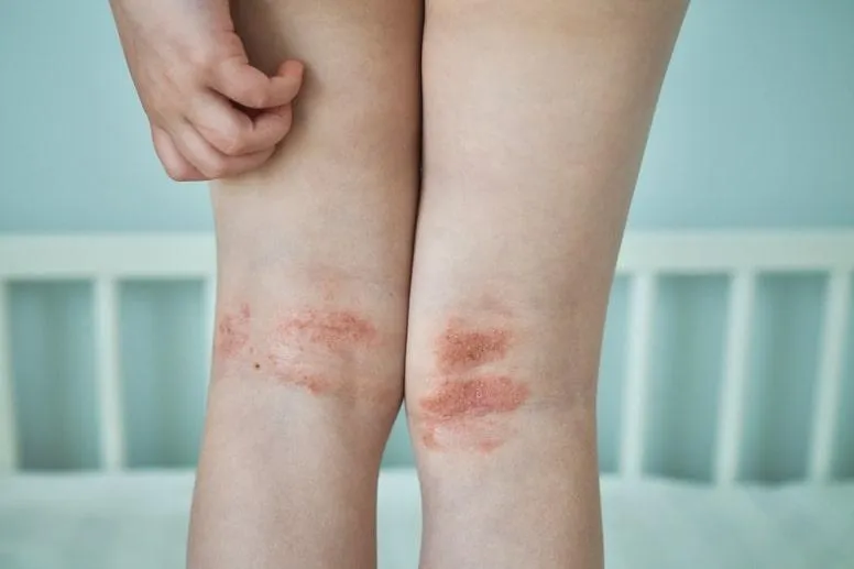 Atopowe zapalenie skóry (AZS) u dzieci – przyczyny, objawy i leczenie