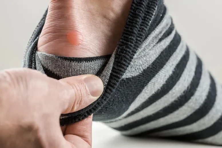 Pęcherze na stopach – jak powstają i jak się ich pozbyć?