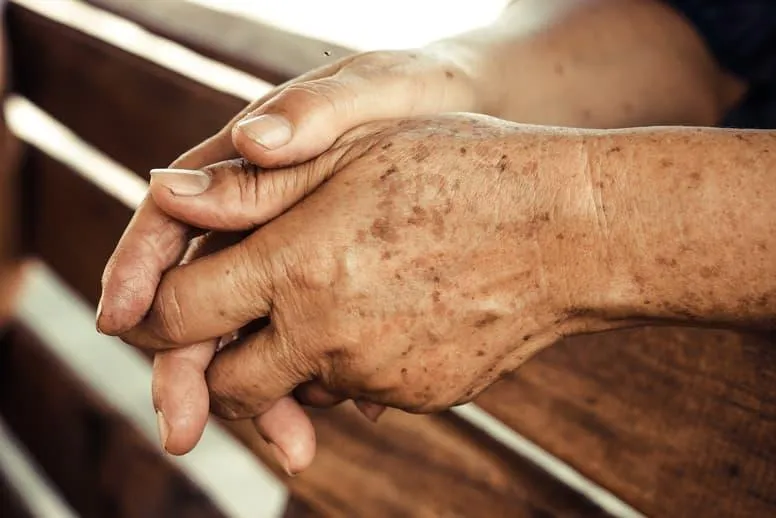 Plamy starcze na dłoniach – jakie są przyczyny i jak zlikwidować przebarwienia starcze na rękach?