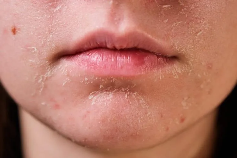 Łuszcząca się skóra na twarzy – jakie są przyczyny i jak sobie z tym radzić?