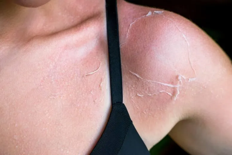 Schodząca skóra po opalaniu – jak sobie radzić z łuszczącą się skórą po opalaniu?